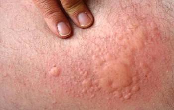 Симптомы аллергии на чихуахуа
