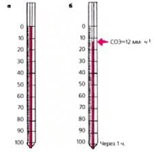 СОЭ - скорость оседания эритроцитов