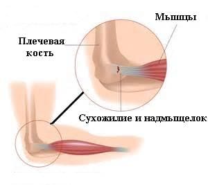 Эпикондилит локтевого сустава