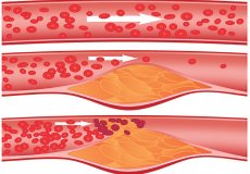 Симптомы и лечение атеросклероза сосудов