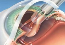 Реабилитация после удаления катаракты