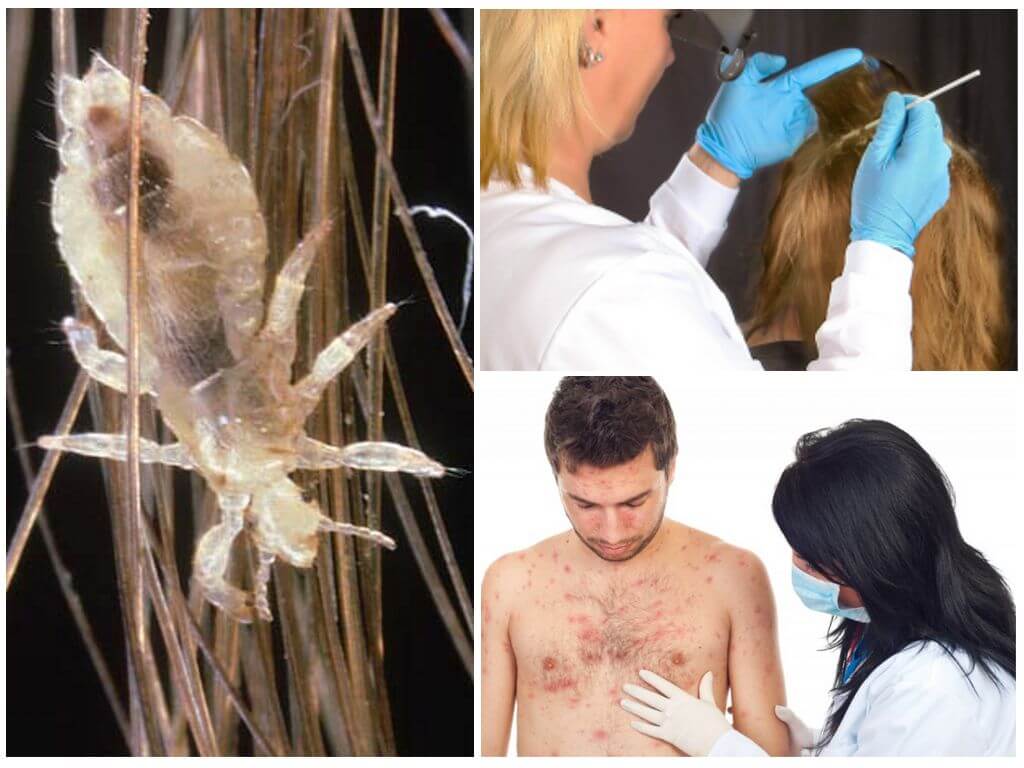 Осмотр на педикулез